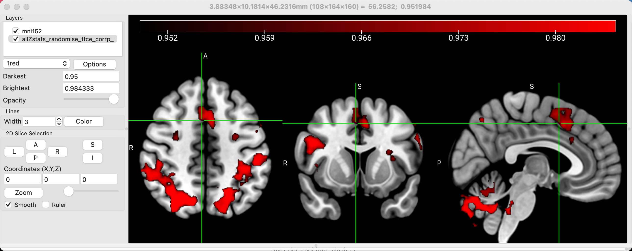 MRIcroGL Tutorial #4: Viewing Results — Andy's Brain Book 1.0 documentation